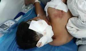 “压在身上乱咬”，湖南10岁男童遭阿拉斯加犬咬伤，事发三天仍在ICU内抢救